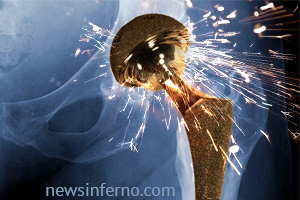NewsInferno.com hip implant