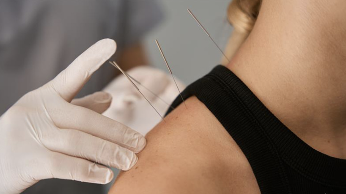 Closeup of acupuncture needles in someone's shoulders