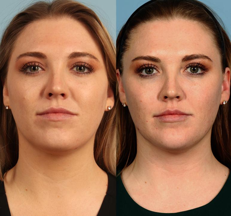 before and after faceshape