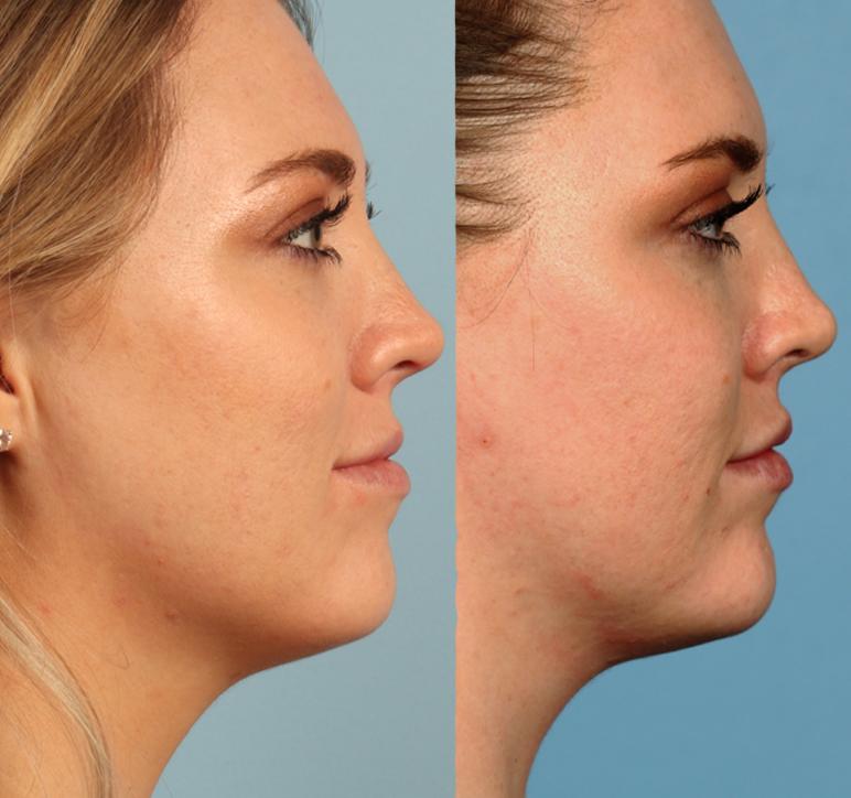 before and after faceshape