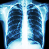 What to Know about Lung Cancer