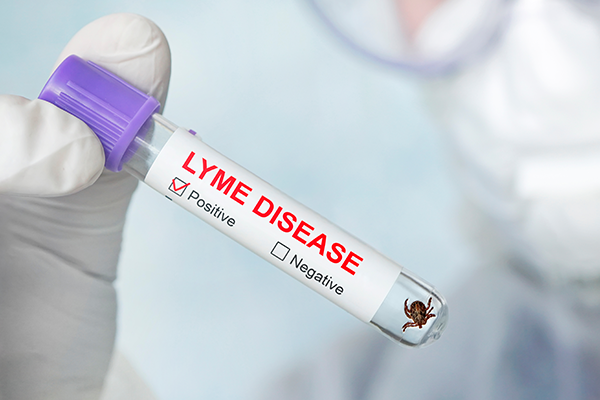 Lyme disease lab test