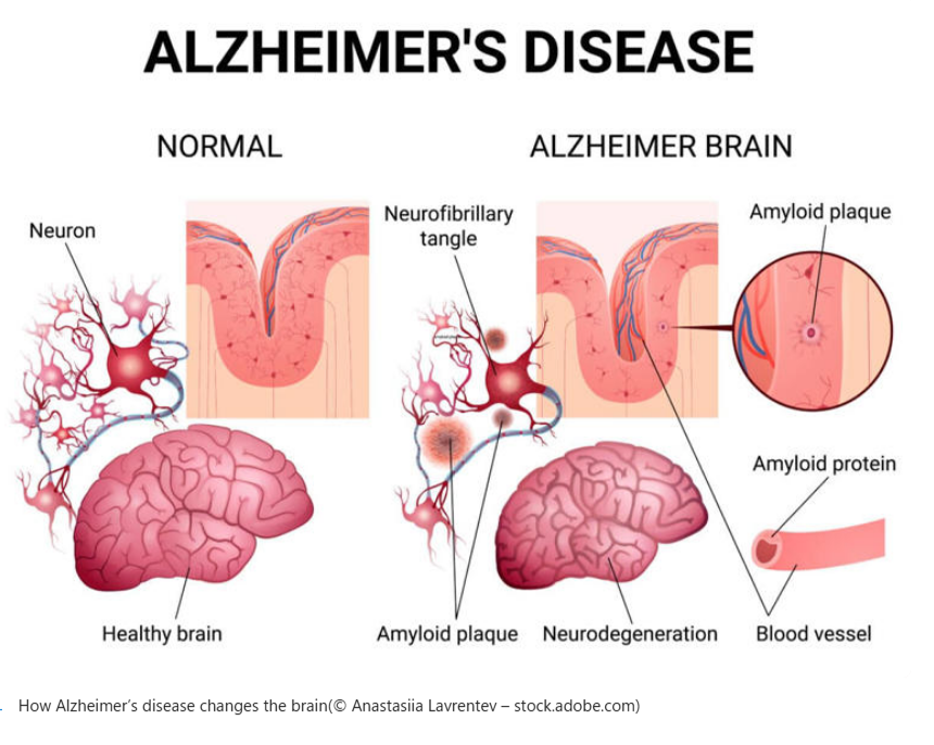 Graphic showing the brain with and without Alzheimer's