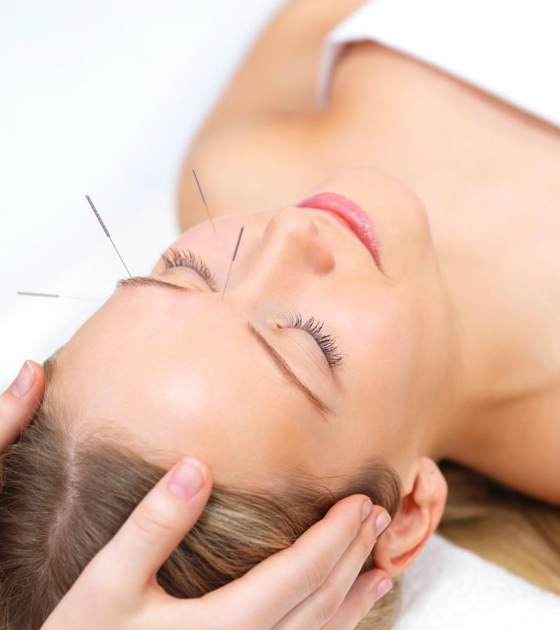 Girl getting acupuncture